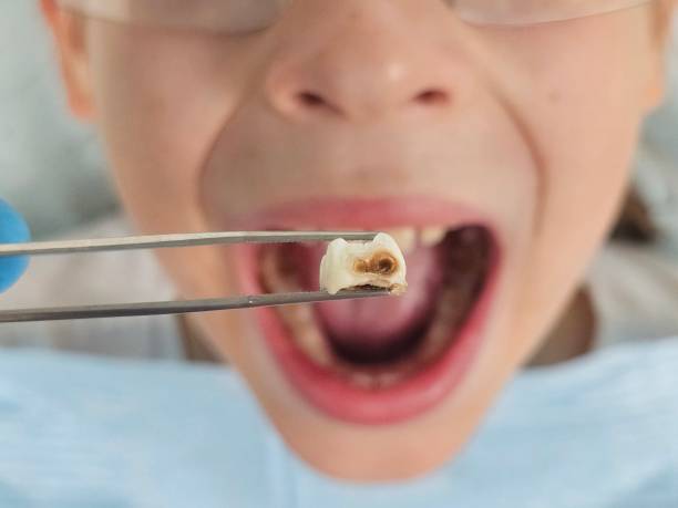 Best Emergency Root Canal Treatment in Mansfield, AR